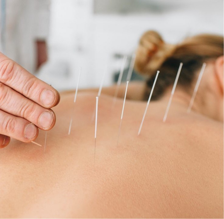 Dry Needling